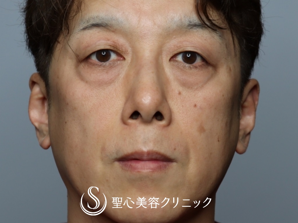 【50代男性・目の下を20歳若く！！】プレミアムPRP皮膚再生療法＋結膜側脱脂（1ヶ月後） Before 