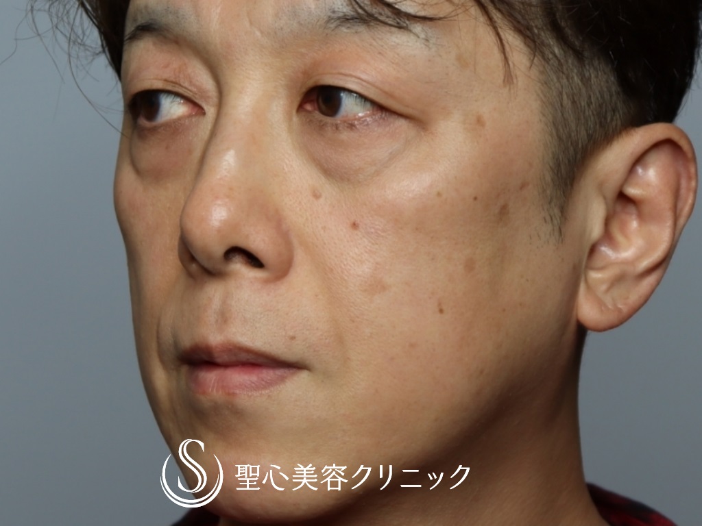 【50代男性・目の下を20歳若く！！】プレミアムPRP皮膚再生療法＋結膜側脱脂（1ヶ月後） Before 