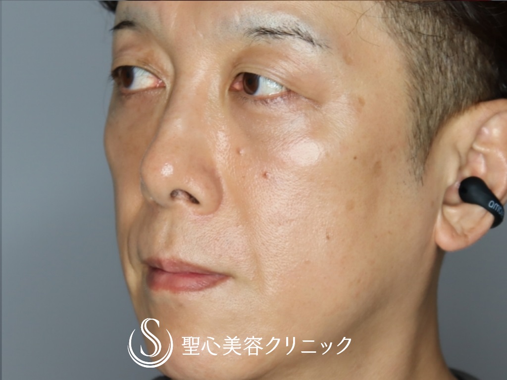 【50代男性・目の下を20歳若く！！】プレミアムPRP皮膚再生療法＋結膜側脱脂（1ヶ月後） After 