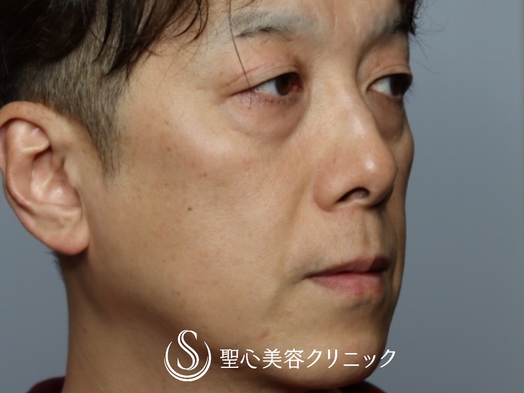 【50代男性・目の下を20歳若く！！】プレミアムPRP皮膚再生療法＋結膜側脱脂（1ヶ月後） Before 