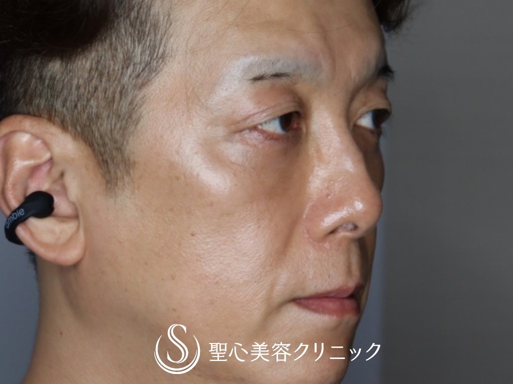 【50代男性・目の下を20歳若く！！】プレミアムPRP皮膚再生療法＋結膜側脱脂（1ヶ月後） After 