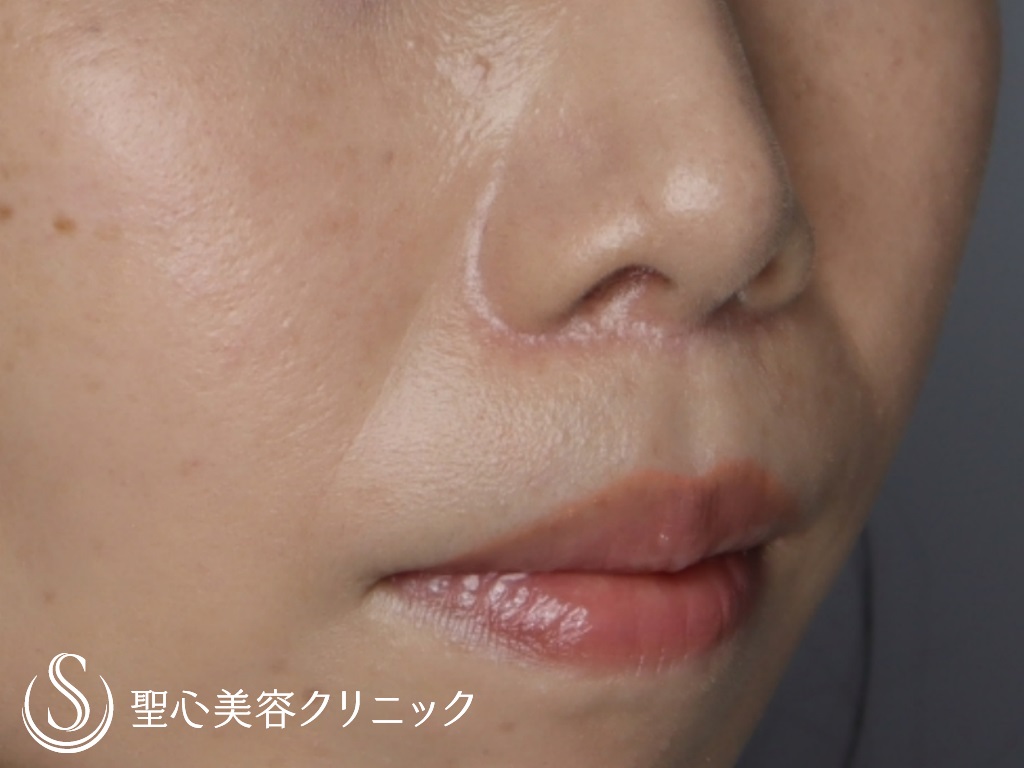 【30代女性・口元のバランスを良く】リップリフト（3ヶ月後） After 