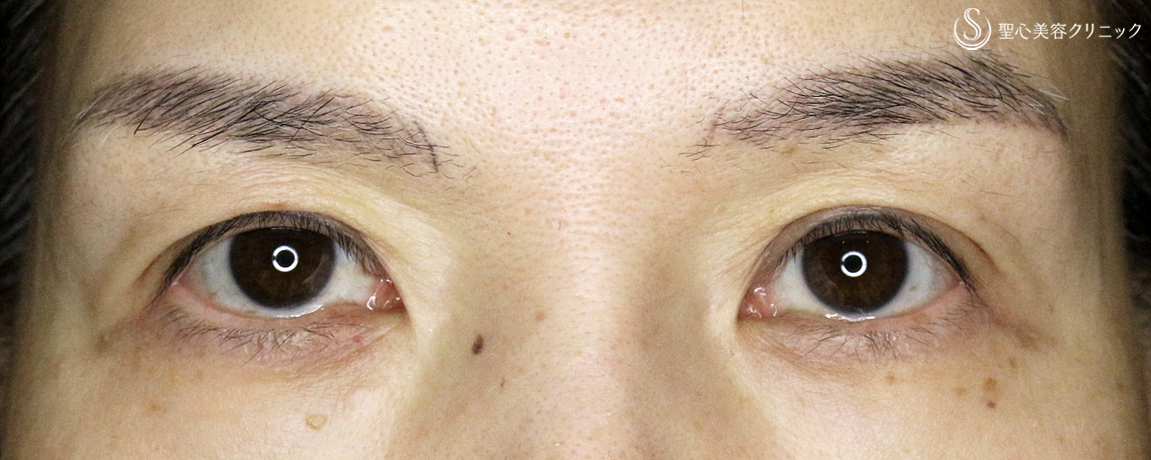 【50代女性・くぼみ目の改善効果も】「切らない眼瞼下垂+α法」単独（7年後） After 
