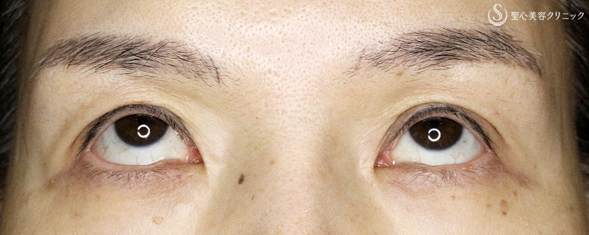 【50代女性・くぼみ目の改善効果も】「切らない眼瞼下垂+α法」単独（7年後） After 