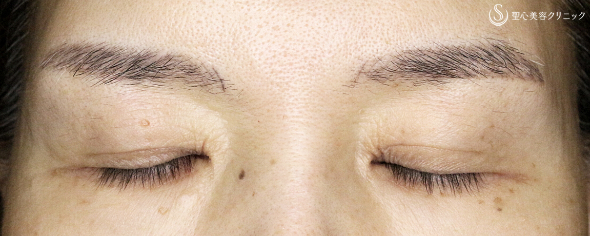 【50代女性・くぼみ目の改善効果も】「切らない眼瞼下垂+α法」単独（7年後） After 