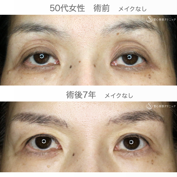 【50代女性・くぼみ目の改善効果も】「切らない眼瞼下垂+α法」単独（7年後） After 