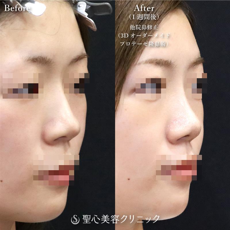 【20代女性・他院 鼻のプロテーゼのズレ修正】 プロテーゼ取り出し・入替＋3Dオーダーメイドプロテーゼ隆鼻術（1週間後） After 