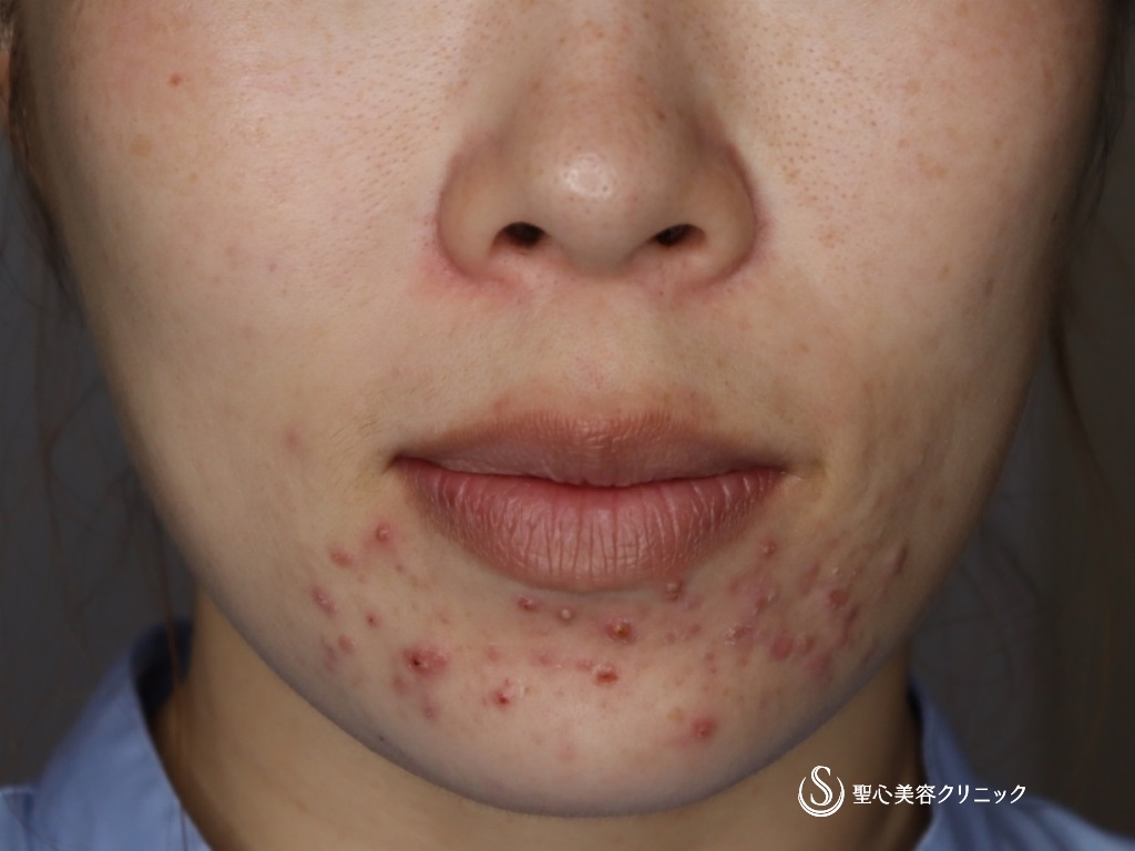 【30代女性・自然で綺麗な口角に】プレミアム口角挙上術＋アグネスによるニキビ治療（1ヶ月後） Before 