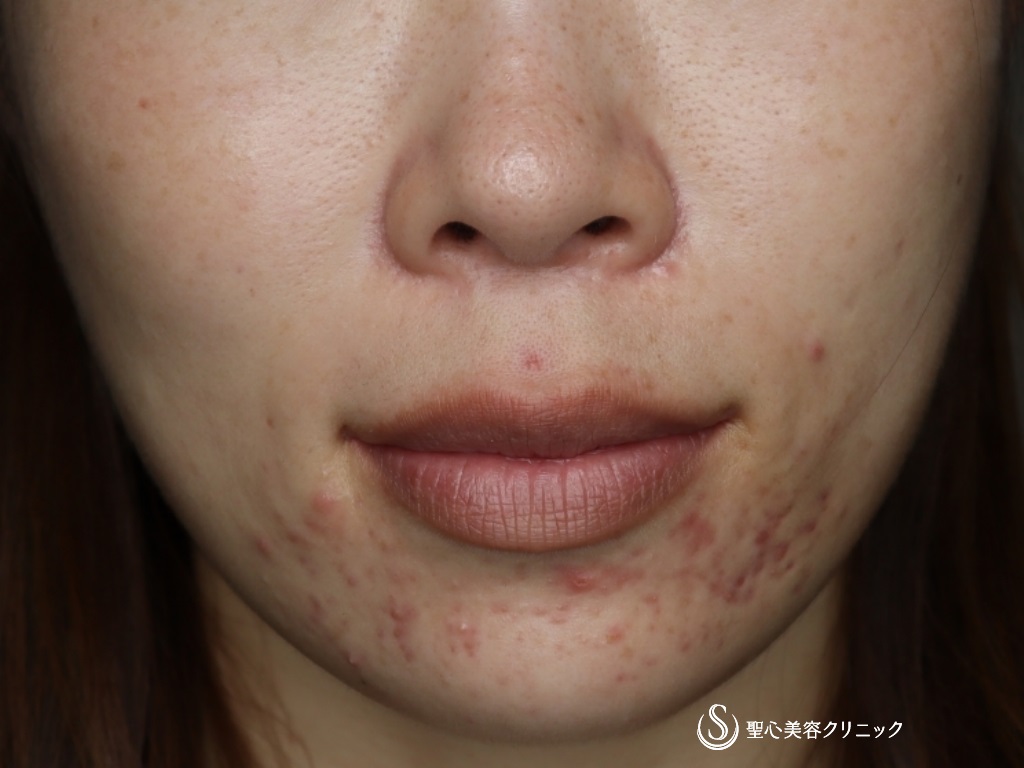 【30代女性・自然で綺麗な口角に】プレミアム口角挙上術＋アグネスによるニキビ治療（1ヶ月後） After 