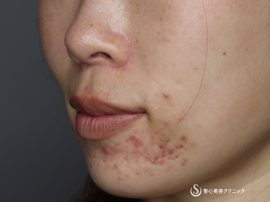【30代女性・自然で綺麗な口角に】プレミアム口角挙上術＋アグネスによるニキビ治療（1ヶ月後） After 