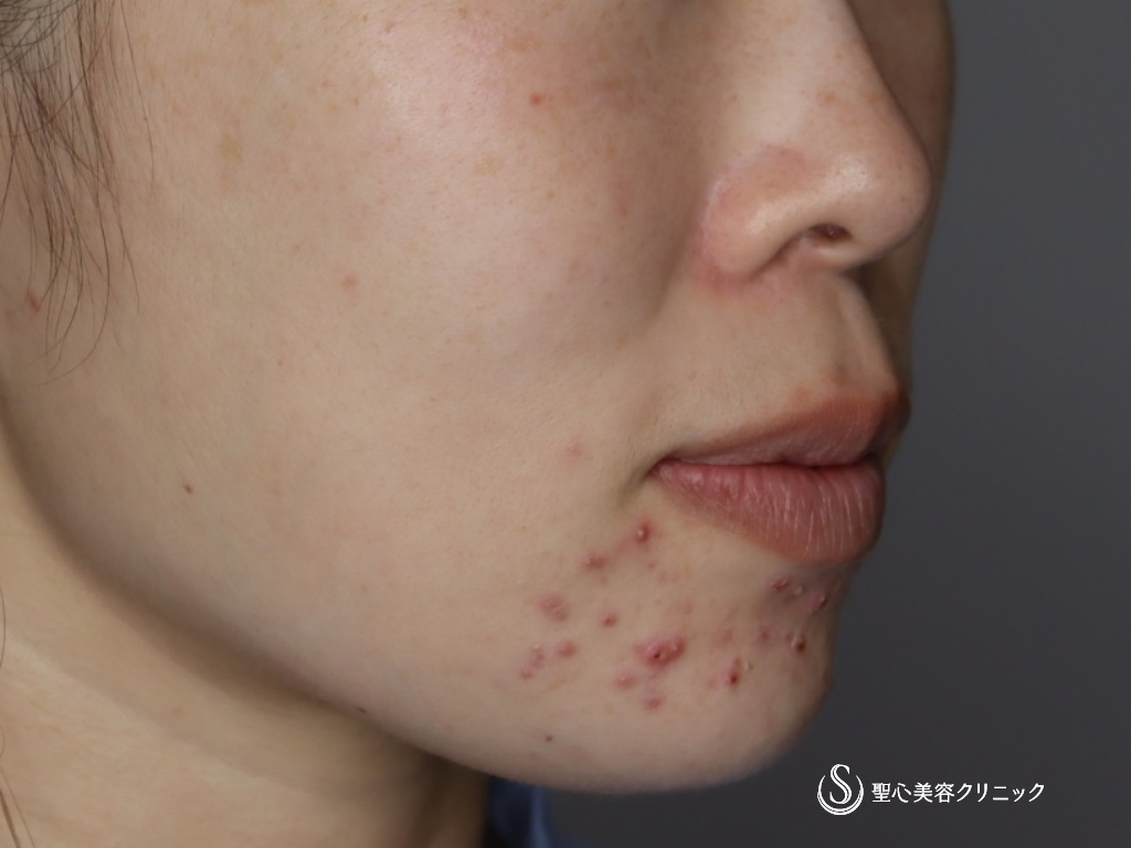 【30代女性・自然で綺麗な口角に】プレミアム口角挙上術＋アグネスによるニキビ治療（1ヶ月後） Before 