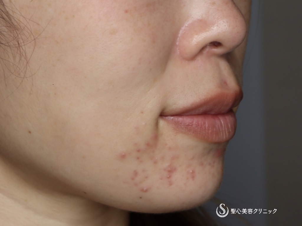 【30代女性・自然で綺麗な口角に】プレミアム口角挙上術＋アグネスによるニキビ治療（1ヶ月後） After 