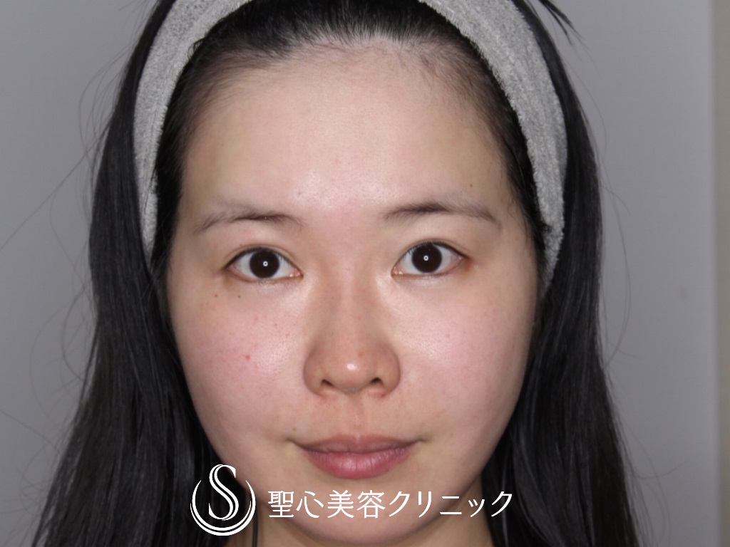 【30代女性・額こめかみをふっくらと】プレミアムPRP皮膚再生療法（半年後） Before 