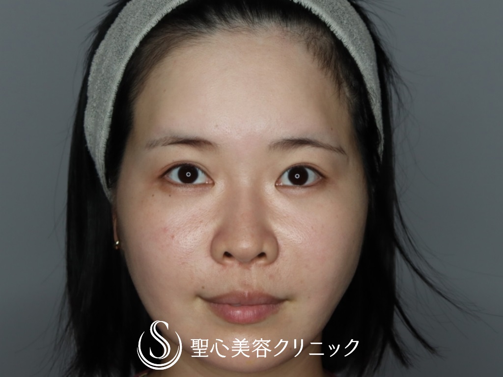 【30代女性・額こめかみをふっくらと】プレミアムPRP皮膚再生療法（半年後） After 