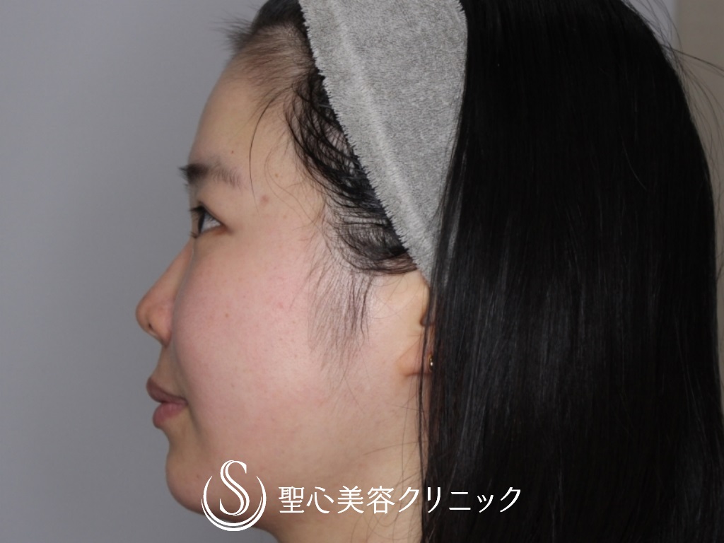 【30代女性・額こめかみをふっくらと】プレミアムPRP皮膚再生療法（半年後） Before 