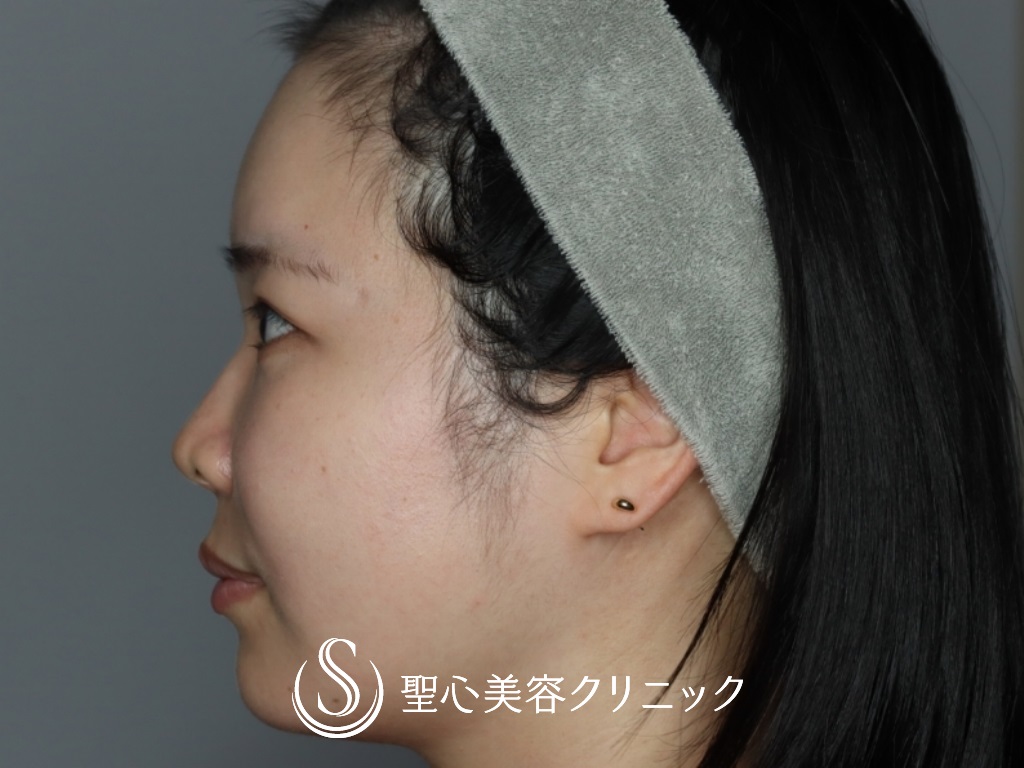 【30代女性・額こめかみをふっくらと】プレミアムPRP皮膚再生療法（半年後） After 