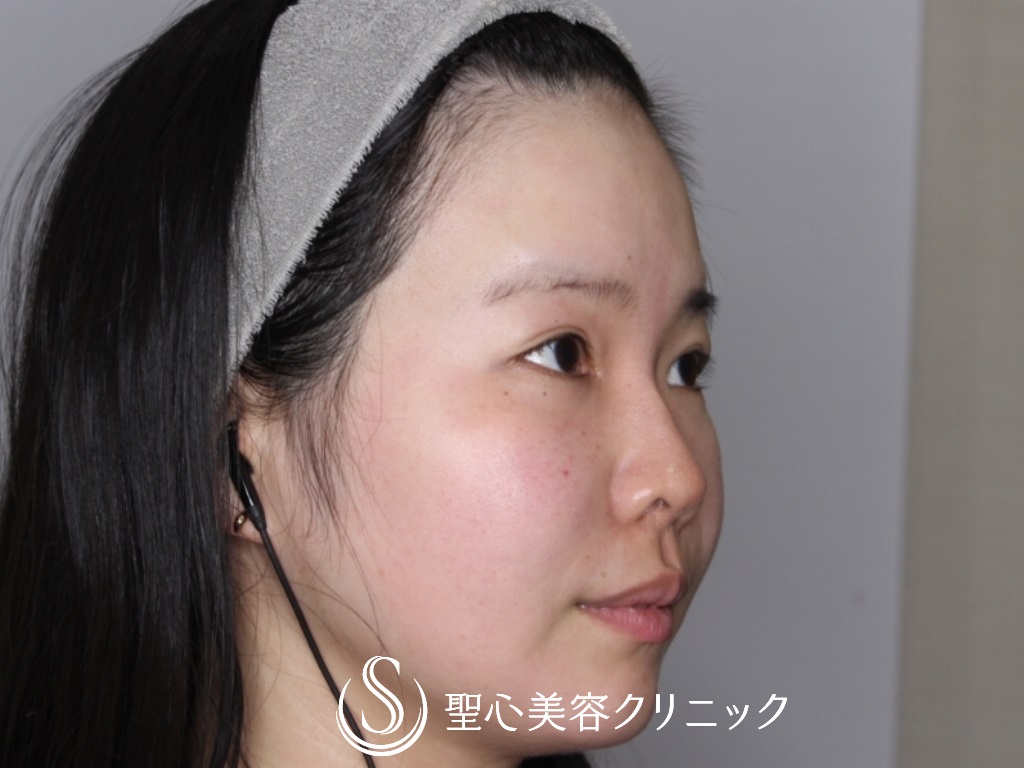 【30代女性・額こめかみをふっくらと】プレミアムPRP皮膚再生療法（半年後） Before 