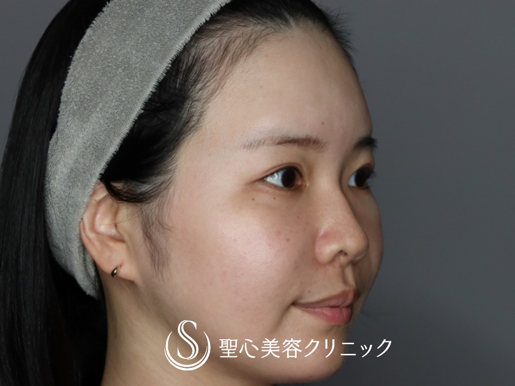 【30代女性・額こめかみをふっくらと】プレミアムPRP皮膚再生療法（半年後） After 