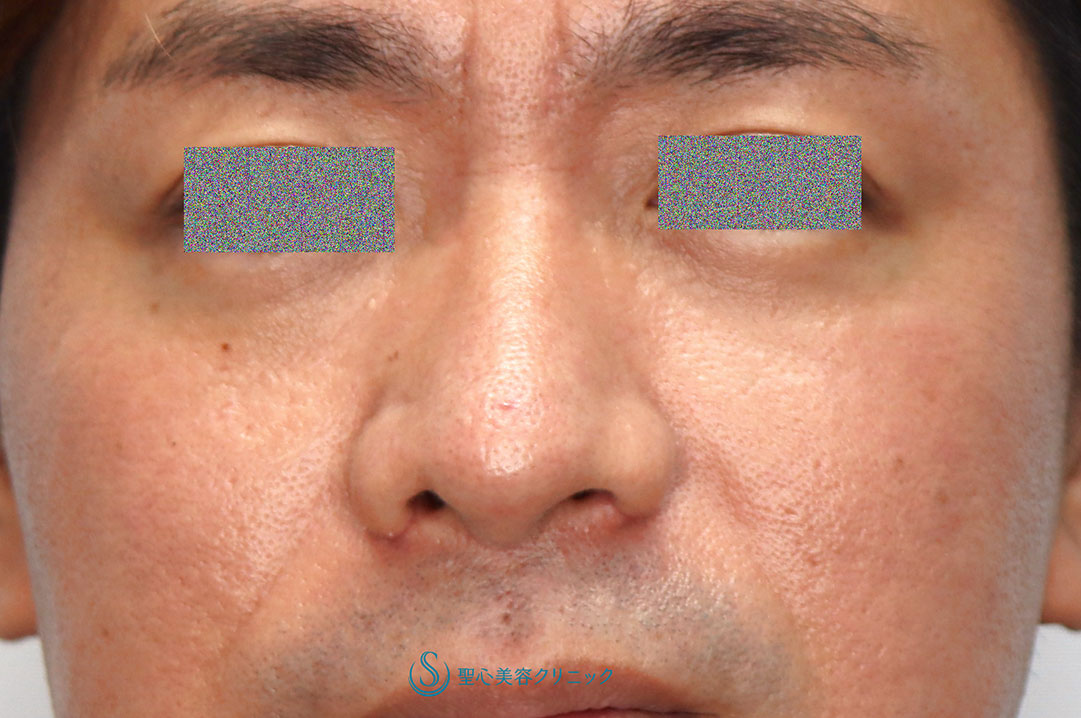 【30代男性・鼻の左右差を矯正しつつ鼻先をスッキリと】鼻尖縮小（オープン法）+鼻尖耳介軟骨移植＋鼻翼（小鼻）縮小（1ヶ月後） After 