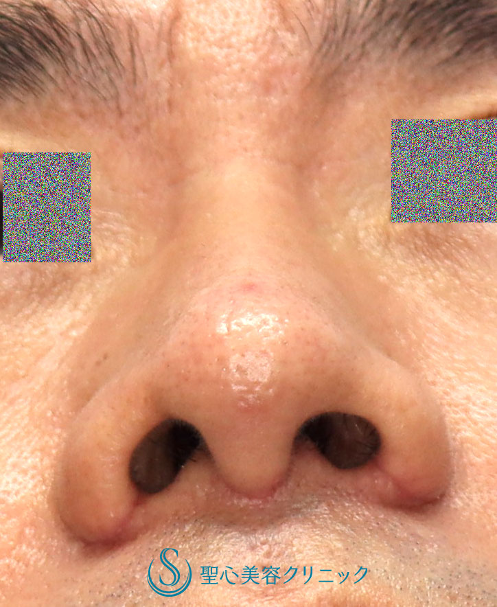 【30代男性・鼻の左右差を矯正しつつ鼻先をスッキリと】鼻尖縮小（オープン法）+鼻尖耳介軟骨移植＋鼻翼（小鼻）縮小（1ヶ月後） After 