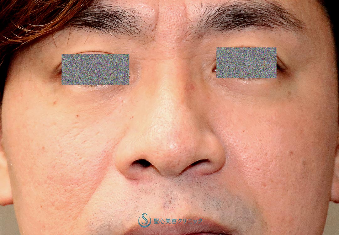 【30代男性・鼻の左右差を矯正しつつ鼻先をスッキリと】鼻尖縮小（オープン法）+鼻尖耳介軟骨移植＋鼻翼（小鼻）縮小（1ヶ月後） Before 