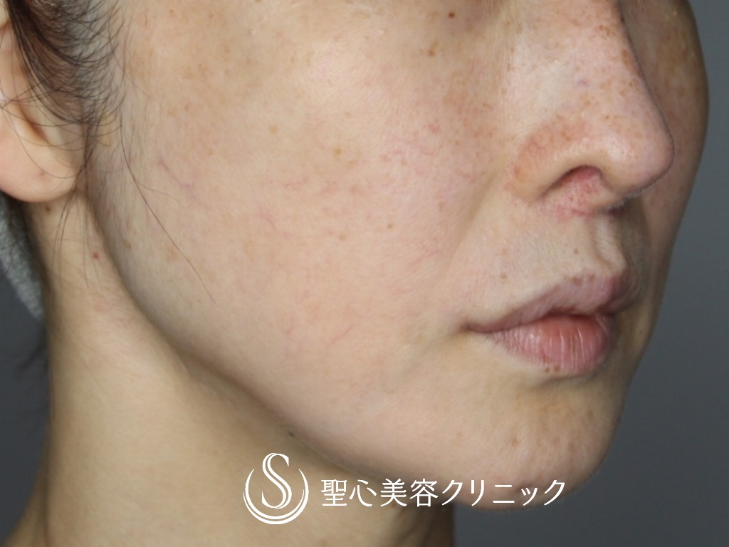 【40代女性・鼻の穴の輪郭を下げて目立たなく】鼻孔縁下降術（1ヶ月後） Before 
