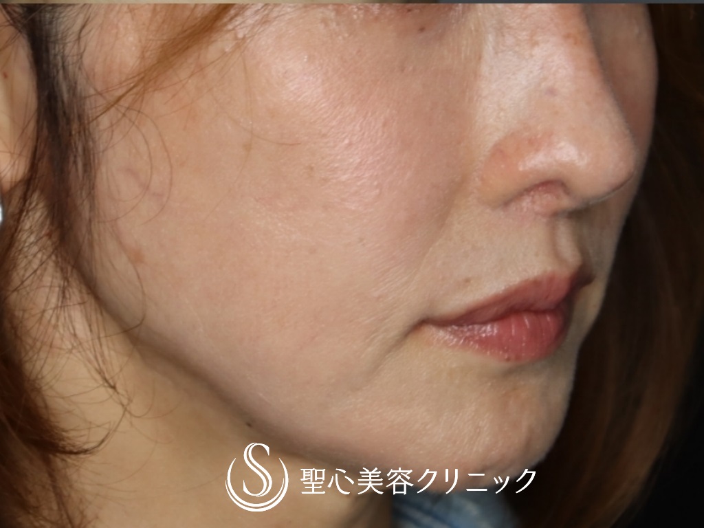 【40代女性・鼻の穴の輪郭を下げて目立たなく】鼻孔縁下降術（1ヶ月後） After 