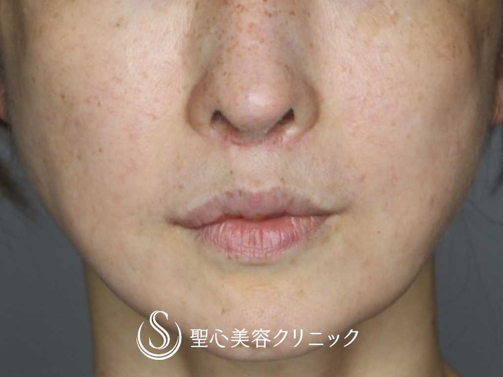 【40代女性・鼻の穴の輪郭を下げて目立たなく】鼻孔縁下降術（1ヶ月後） Before 