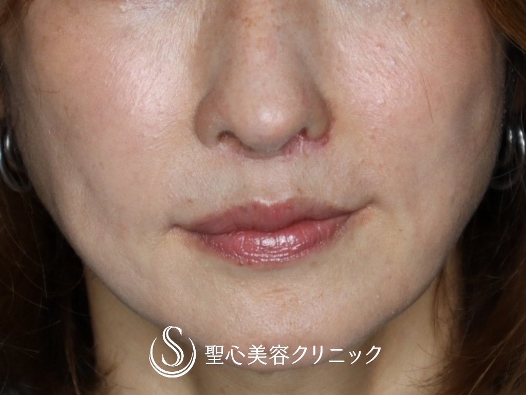 【40代女性・鼻の穴の輪郭を下げて目立たなく】鼻孔縁下降術（1ヶ月後） After 