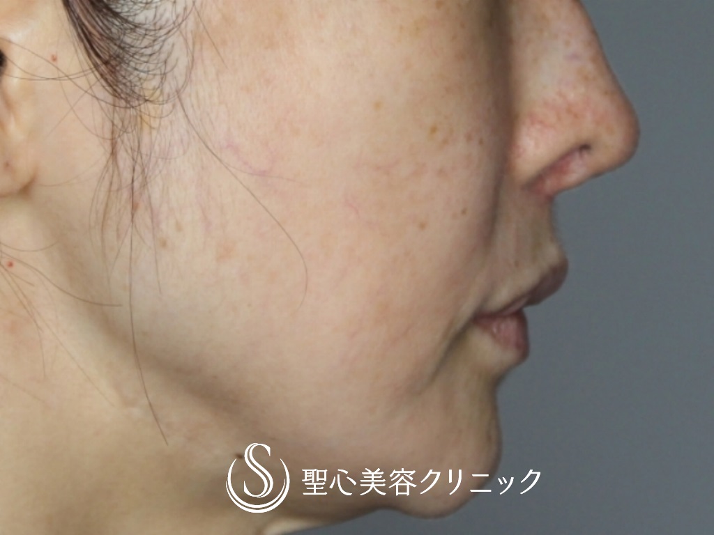 【40代女性・鼻の穴の輪郭を下げて目立たなく】鼻孔縁下降術（1ヶ月後） Before 