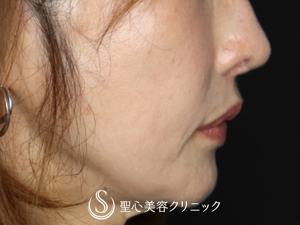 【40代女性・鼻の穴の輪郭を下げて目立たなく】鼻孔縁下降術（1ヶ月後） After 
