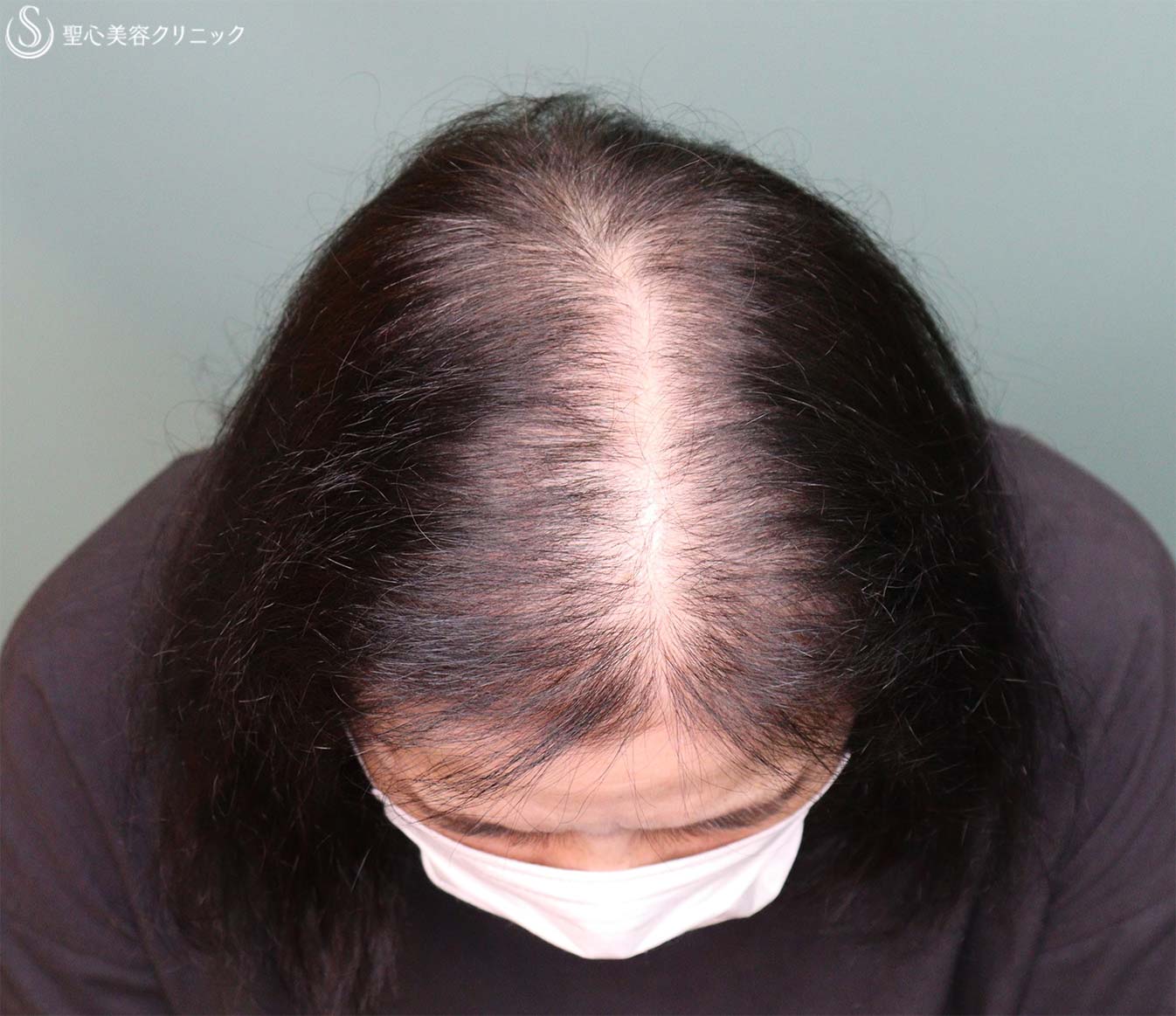 【60代女性・薄毛】EXOHAIR EVs（4回処置後2か月） Before 