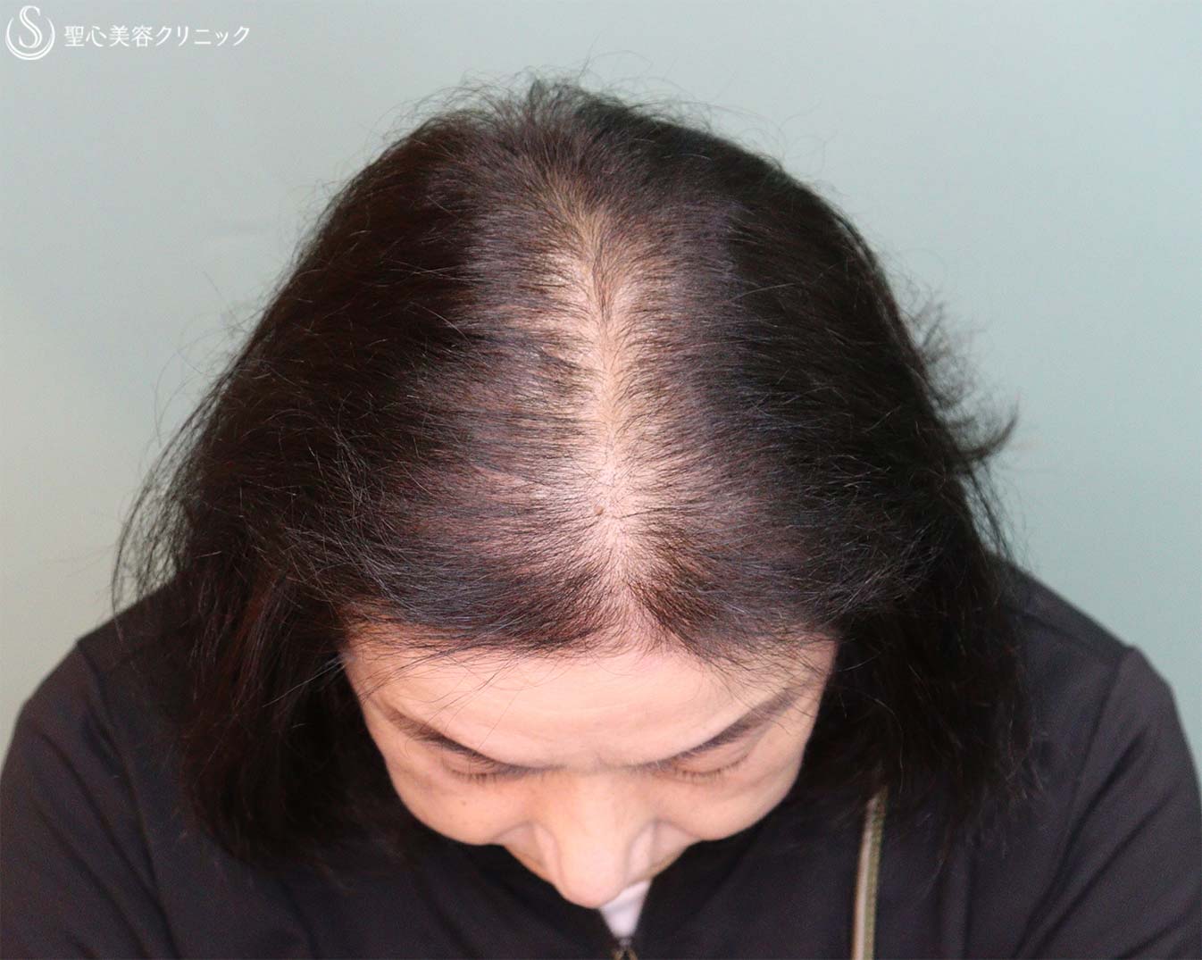 【60代女性・薄毛】EXOHAIR EVs（4回処置後2か月） After 