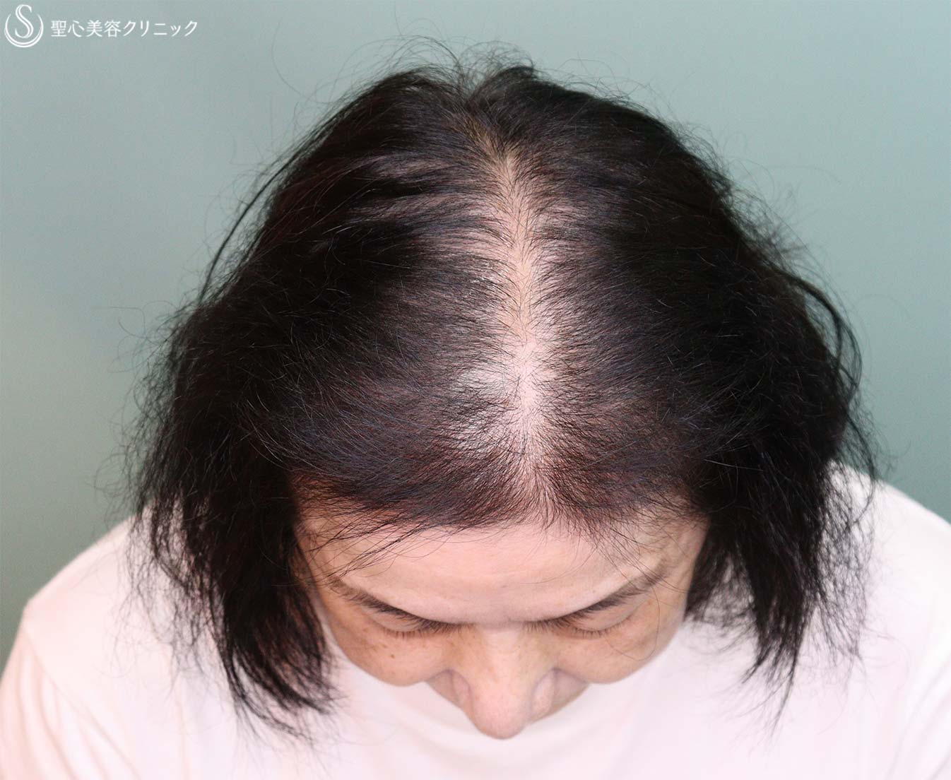 【60代女性・薄毛】EXOHAIR EVs（4回処置後2か月） After 