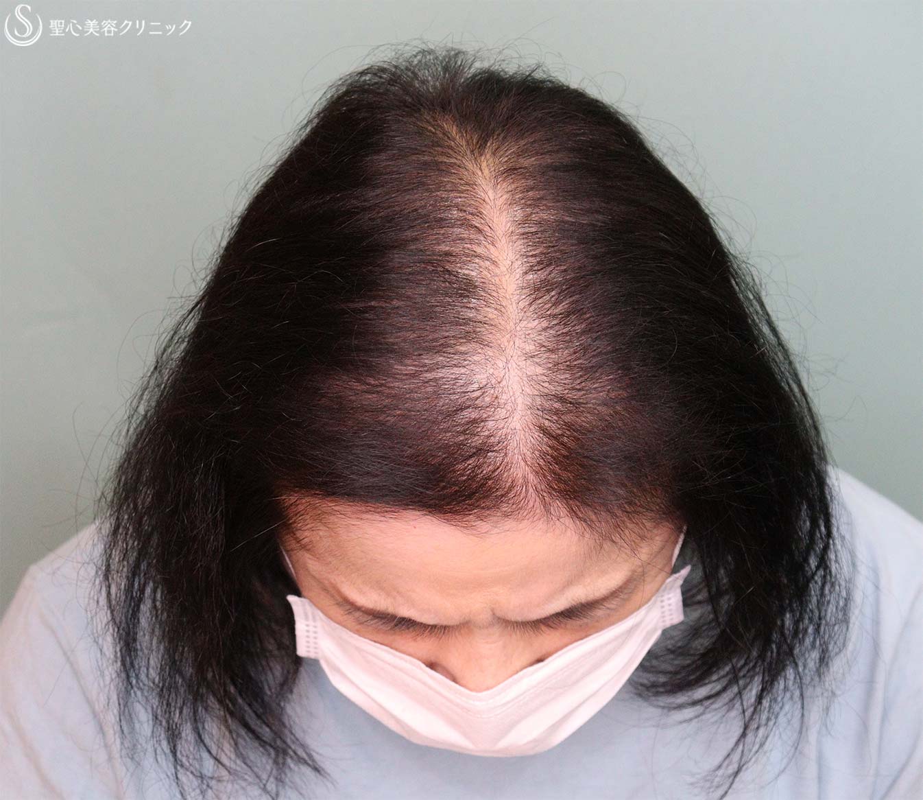 【60代女性・薄毛】EXOHAIR EVs（4回処置後2か月） After 