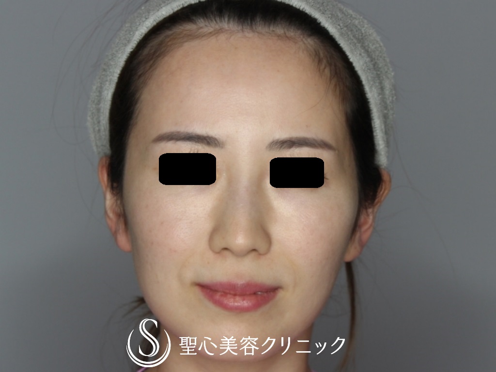 【30代女性・額とこめかみをふっくらと】プレミアムPRP皮膚再生療法（6か月後） Before 