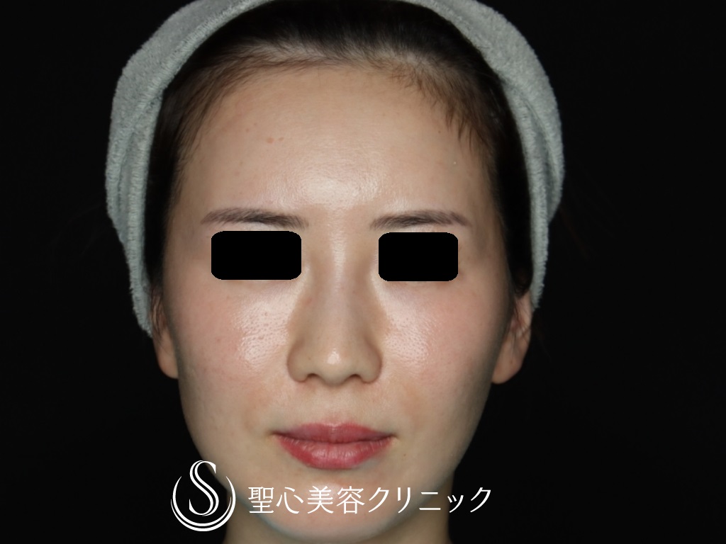 【30代女性・額とこめかみをふっくらと】プレミアムPRP皮膚再生療法（6か月後） After 