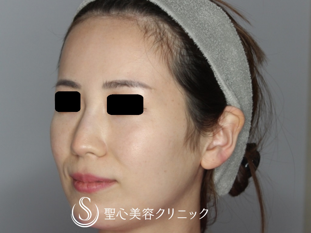 【30代女性・額とこめかみをふっくらと】プレミアムPRP皮膚再生療法（6か月後） Before 