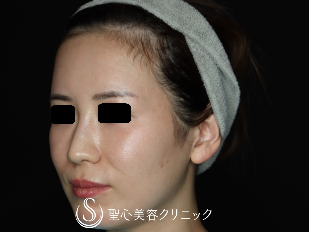 【30代女性・額とこめかみをふっくらと】プレミアムPRP皮膚再生療法（6か月後） After 