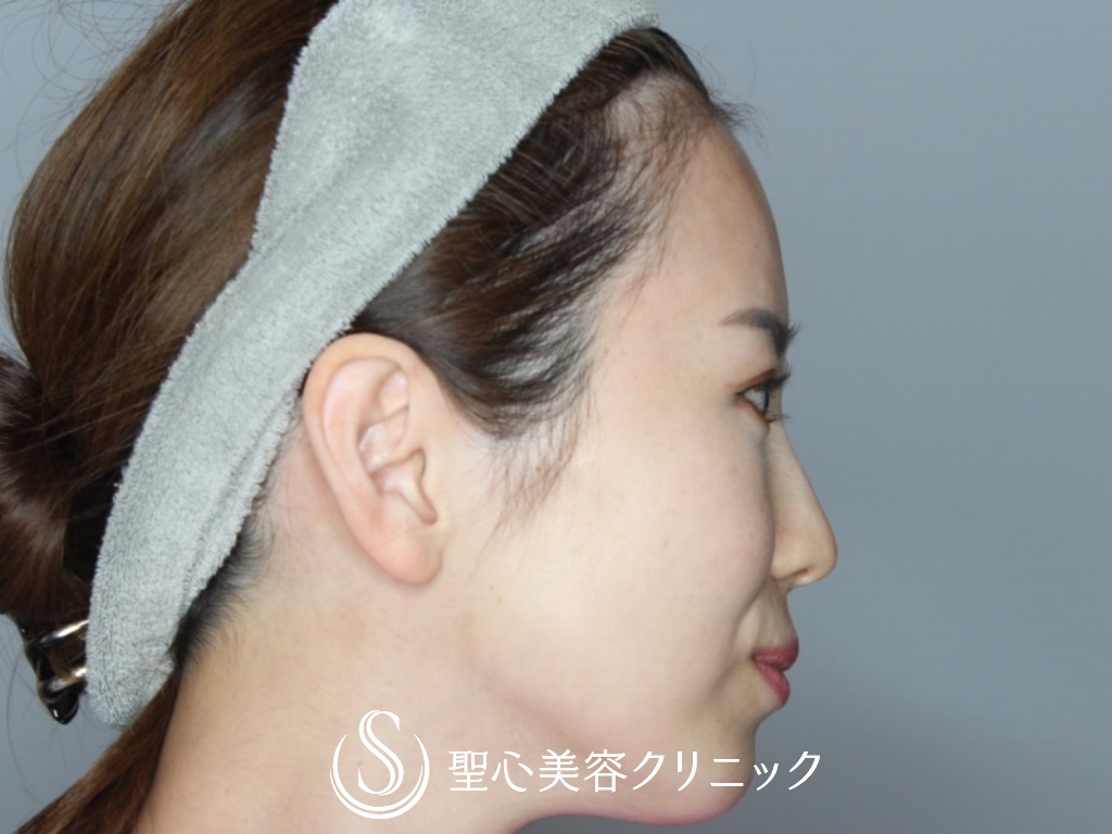 【30代女性・額とこめかみをふっくらと】プレミアムPRP皮膚再生療法（6か月後） Before 