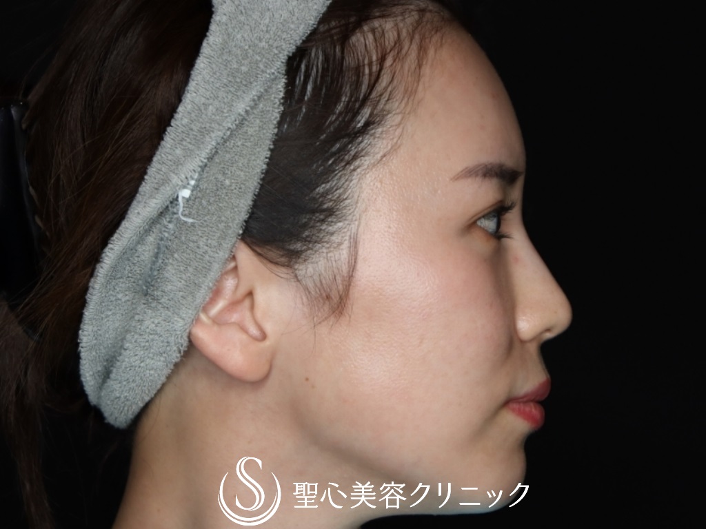 【30代女性・額とこめかみをふっくらと】プレミアムPRP皮膚再生療法（6か月後） After 