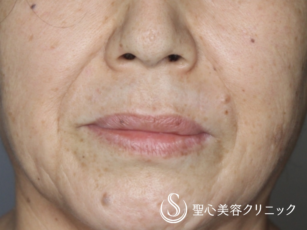 【60代女性・鼻下を短く】リップリフト（術後1か月） Before 