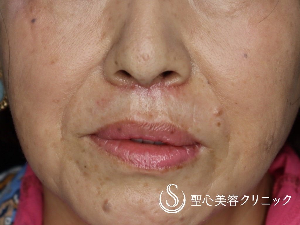 【60代女性・鼻下を短く】リップリフト（術後1か月） After 