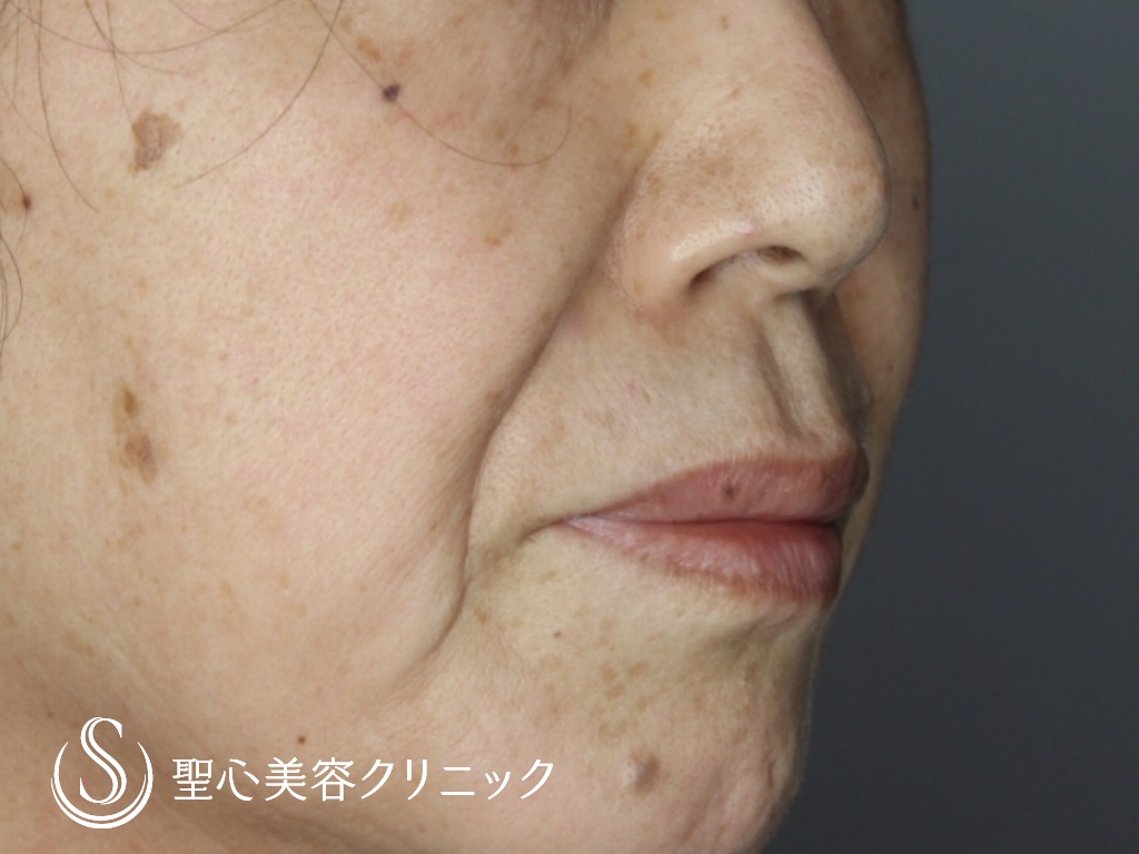【60代女性・鼻下を短く】リップリフト（術後1か月） Before 