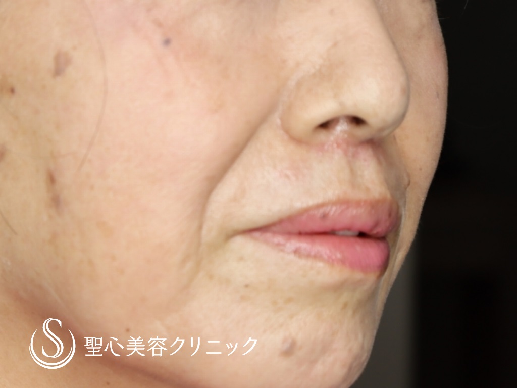 【60代女性・鼻下を短く】リップリフト（術後1か月） After 
