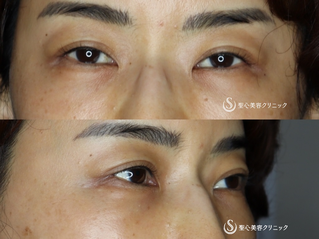 【40代女性・つり目をたれ目に】グラマラスライン（切開）+目尻切開（術後1か月半） Before 