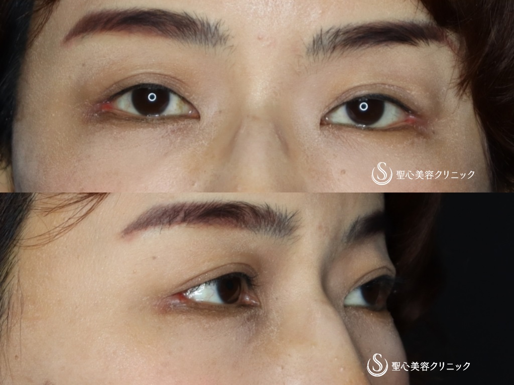 【40代女性・つり目をたれ目に】グラマラスライン（切開）+目尻切開（術後1か月半） After 