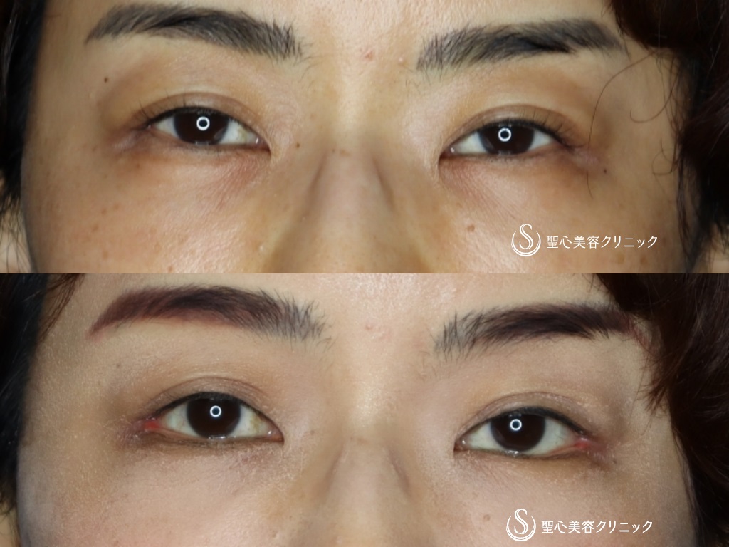 【40代女性・つり目をたれ目に】グラマラスライン（切開）+目尻切開（術後1か月半） After 