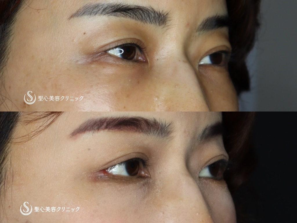 【40代女性・つり目をたれ目に】グラマラスライン（切開）+目尻切開（術後1か月半） After 