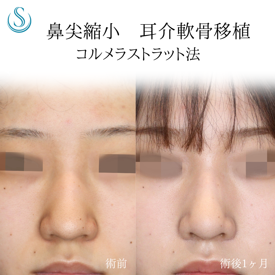 【10代女性・鼻先をスッと！！】鼻尖形成（耳介軟骨移植）+鼻尖縮小（1ヶ月後） Before 